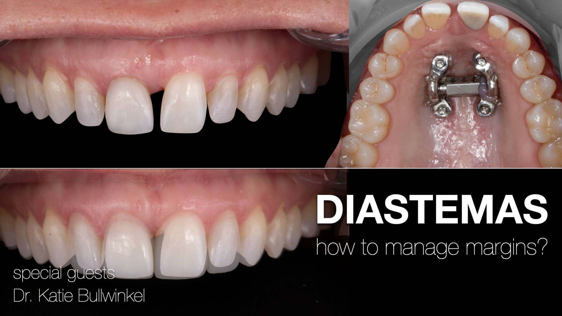 Diastemas: How to Manage Margins